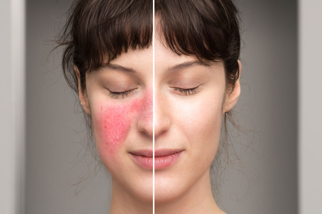 What To Expect From Our Best Facial For Rosacea