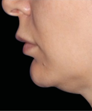 emface with exion treatments before