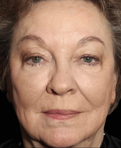 Emface with Exion treatments After