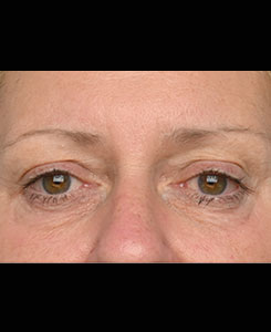 emface-eyes-after